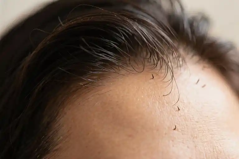 Stress Hair Loss Recovery Signs and Solutions  